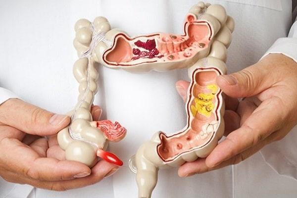 Crohn Hastalığı
